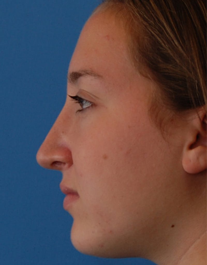 Rhinoplasty Before & After Gallery - Patient 248759 - Image 4