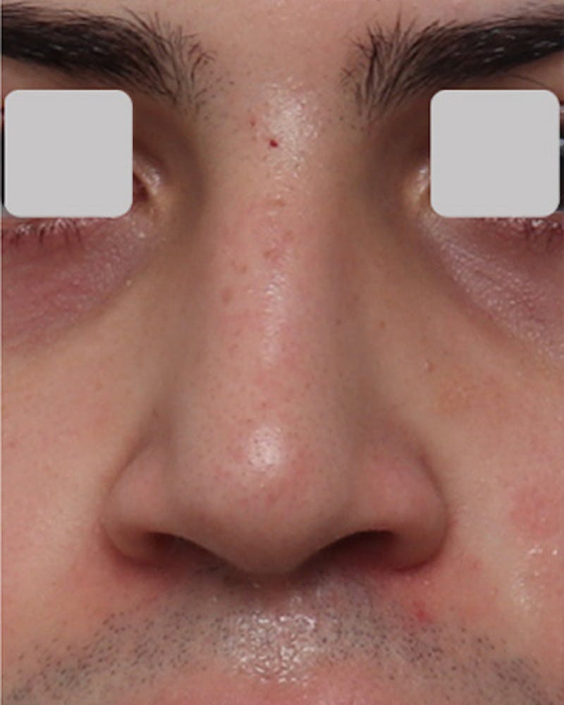 Rhinoplasty Before & After Gallery - Patient 851880 - Image 4