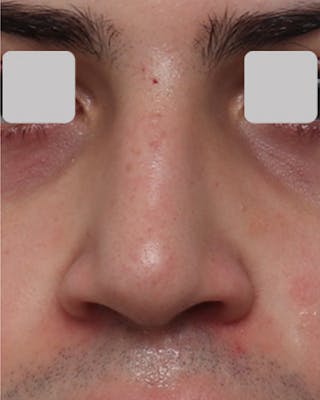 Non-Surgical Rhinoplasty Before & After Gallery - Patient 271700 - Image 4