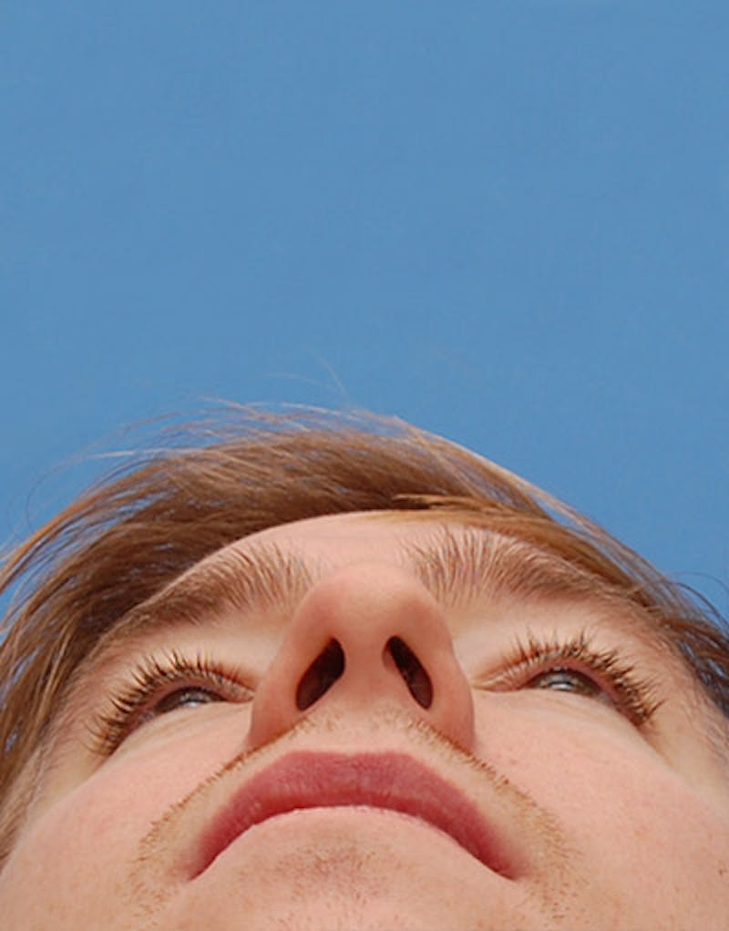 Rhinoplasty  Before & After Gallery - Patient 167615 - Image 8