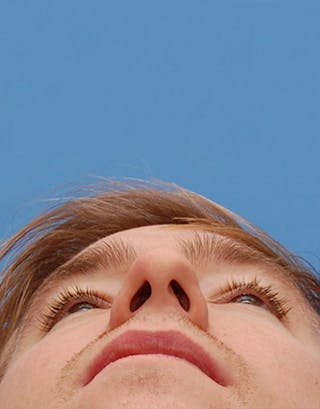 Favorite Foundation Rhinoplasty / Crooked Nose Before & After Gallery - Patient 277500 - Image 8