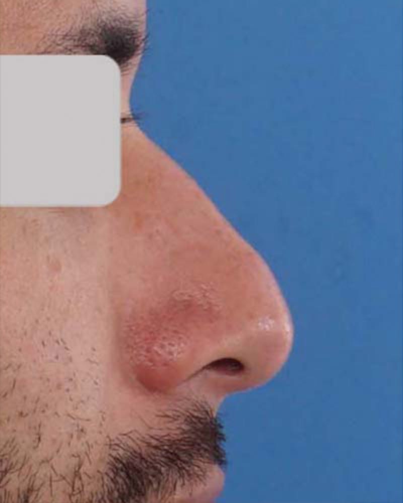 Male Rhinoplasty Before & After Gallery - Patient 364297 - Image 1