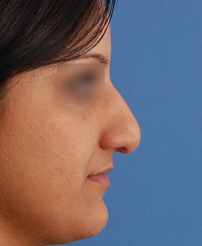 Ethnic Rhinoplasty Before & After Gallery - Patient 668309 - Image 1