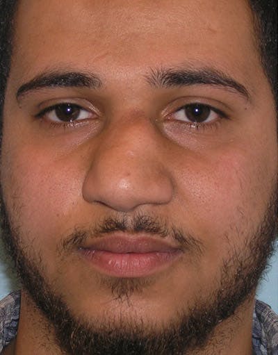 Favorite Foundation Rhinoplasty / Crooked Nose Before & After Gallery - Patient 188072 - Image 1