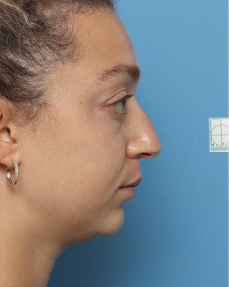 Rhinoplasty Before & After Gallery - Patient 399072 - Image 1