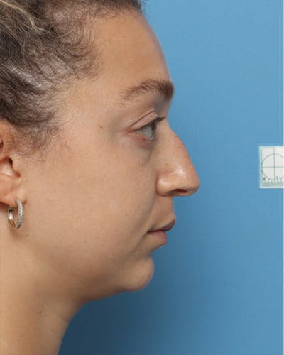 Rhinoplasty Before & After Gallery - Patient 195304 - Image 1
