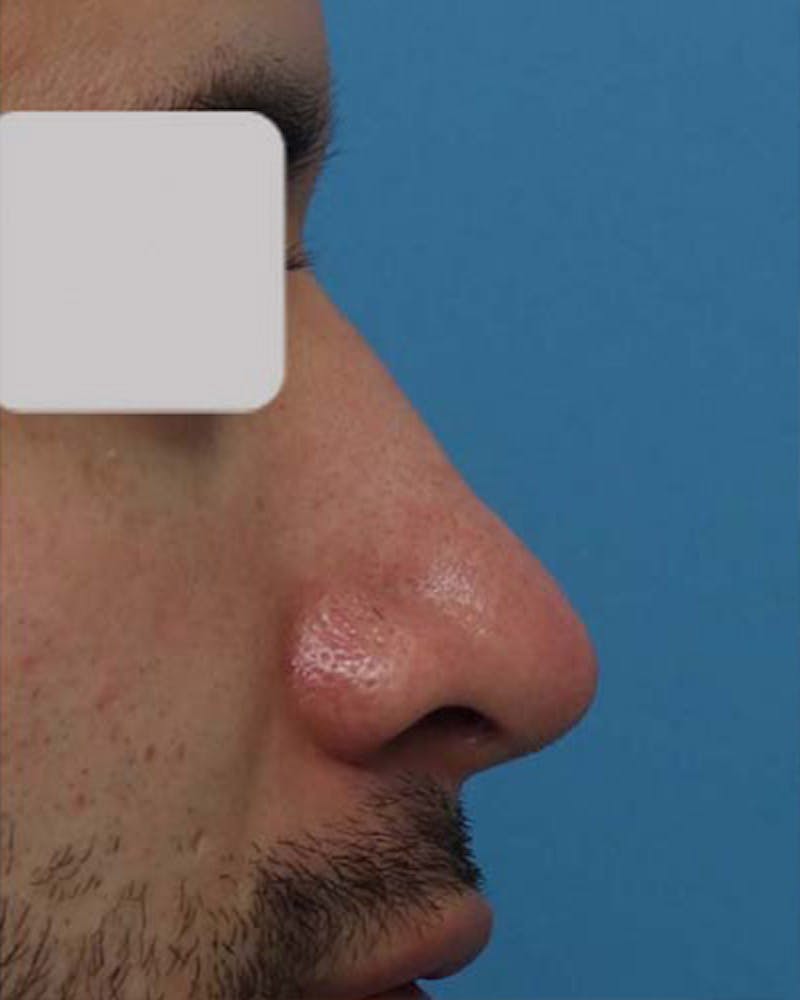 Male Rhinoplasty Before & After Gallery - Patient 364297 - Image 2