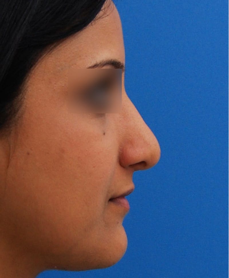 Ethnic Rhinoplasty Before & After Gallery - Patient 668309 - Image 2