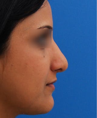 Rhinoplasty Before & After Gallery - Patient 340872 - Image 2