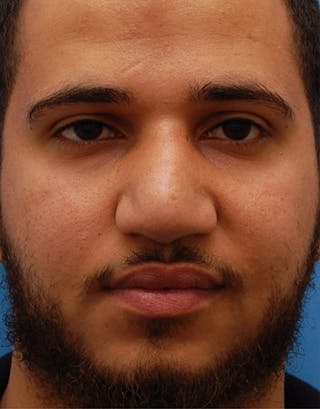 Favorite Foundation Rhinoplasty / Crooked Nose Before & After Gallery - Patient 188072 - Image 2