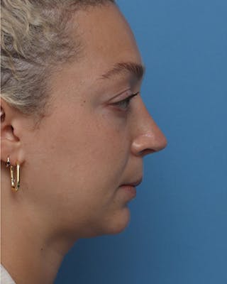 Rhinoplasty Before & After Gallery - Patient 195304 - Image 2