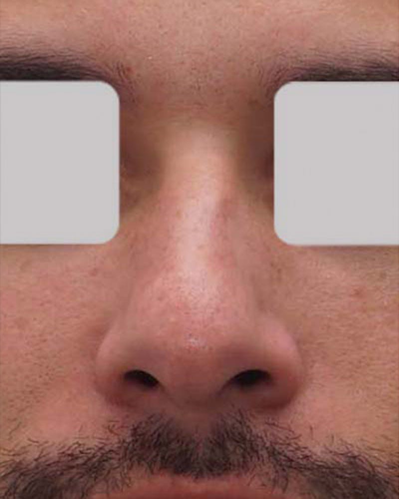 Male Rhinoplasty Before & After Gallery - Patient 364297 - Image 3