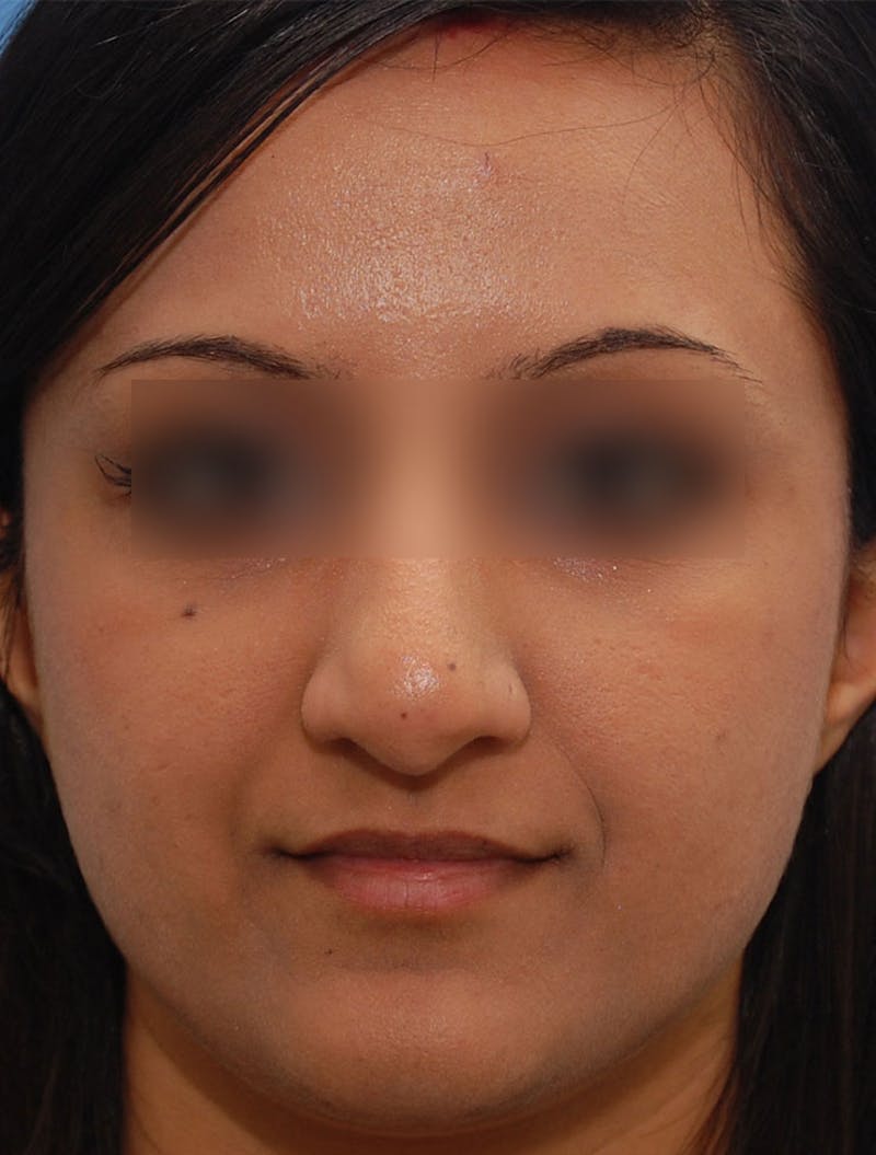 Ethnic Rhinoplasty Before & After Gallery - Patient 668309 - Image 3