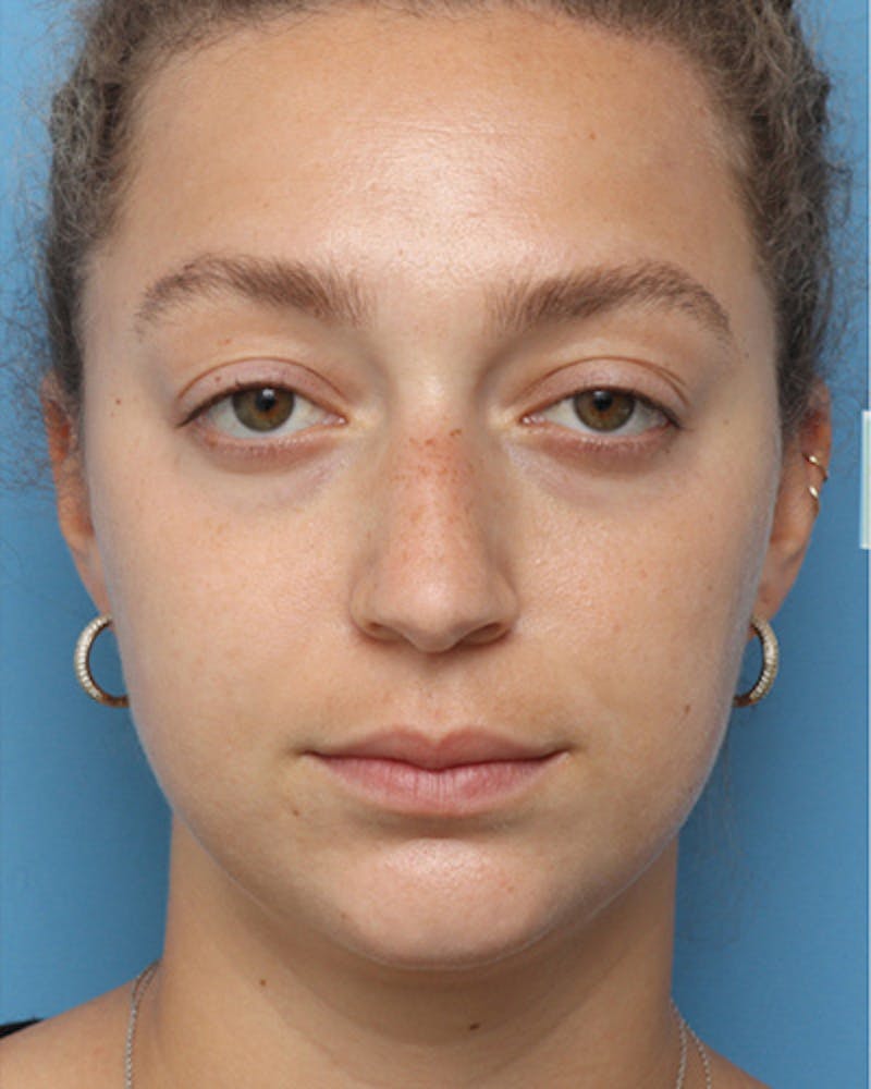 Rhinoplasty Before & After Gallery - Patient 399072 - Image 3