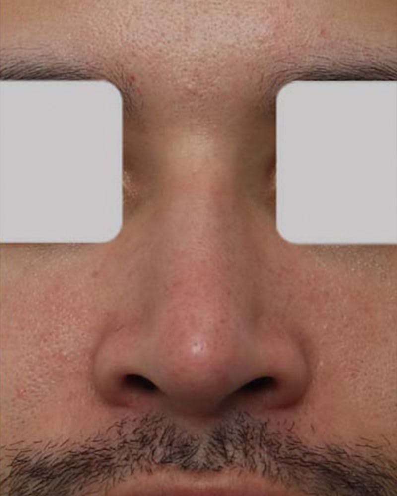 Male Rhinoplasty Before & After Gallery - Patient 364297 - Image 4