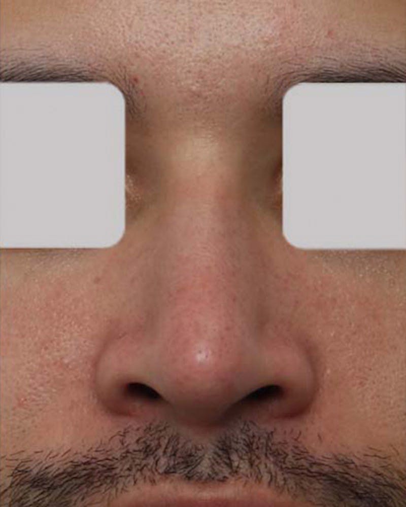 Rhinoplasty  Before & After Gallery - Patient 324227 - Image 4