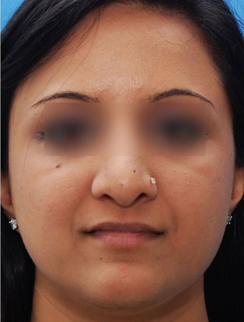 Ethnic Rhinoplasty Before & After Gallery - Patient 668309 - Image 4