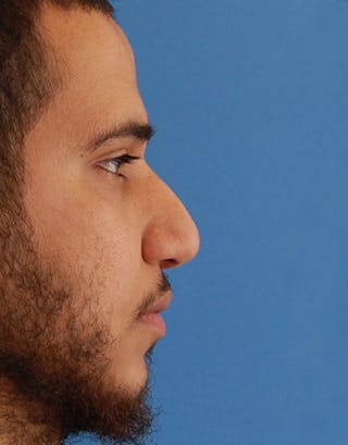 Favorite Foundation Rhinoplasty / Crooked Nose Before & After Gallery - Patient 188072 - Image 4