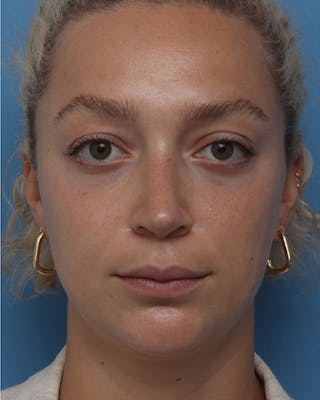 Rhinoplasty Before & After Gallery - Patient 195304 - Image 4