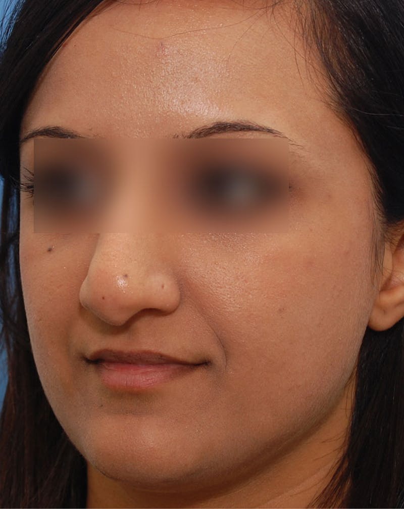 Ethnic Rhinoplasty Before & After Gallery - Patient 668309 - Image 5