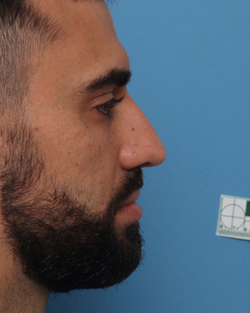 Male Rhinoplasty Before & After Gallery - Patient 221849 - Image 1
