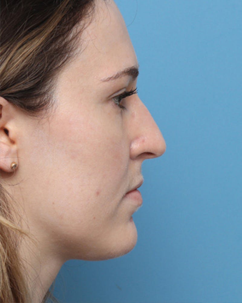 Rhinoplasty Before & After Gallery - Patient 343788 - Image 1