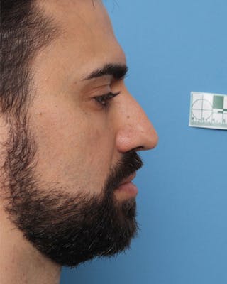 Rhinoplasty Before & After Gallery - Patient 257498 - Image 4