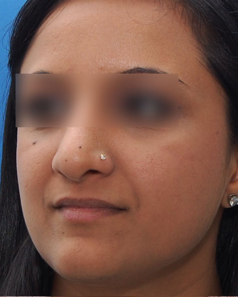 Ethnic Rhinoplasty Before & After Gallery - Patient 668309 - Image 6