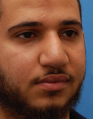 Favorite Foundation Rhinoplasty / Crooked Nose Before & After Gallery - Patient 188072 - Image 6