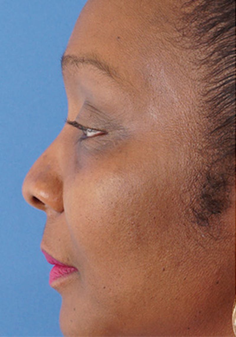 Non-Surgical Rhinoplasty Before & After Gallery - Patient 392646 - Image 3