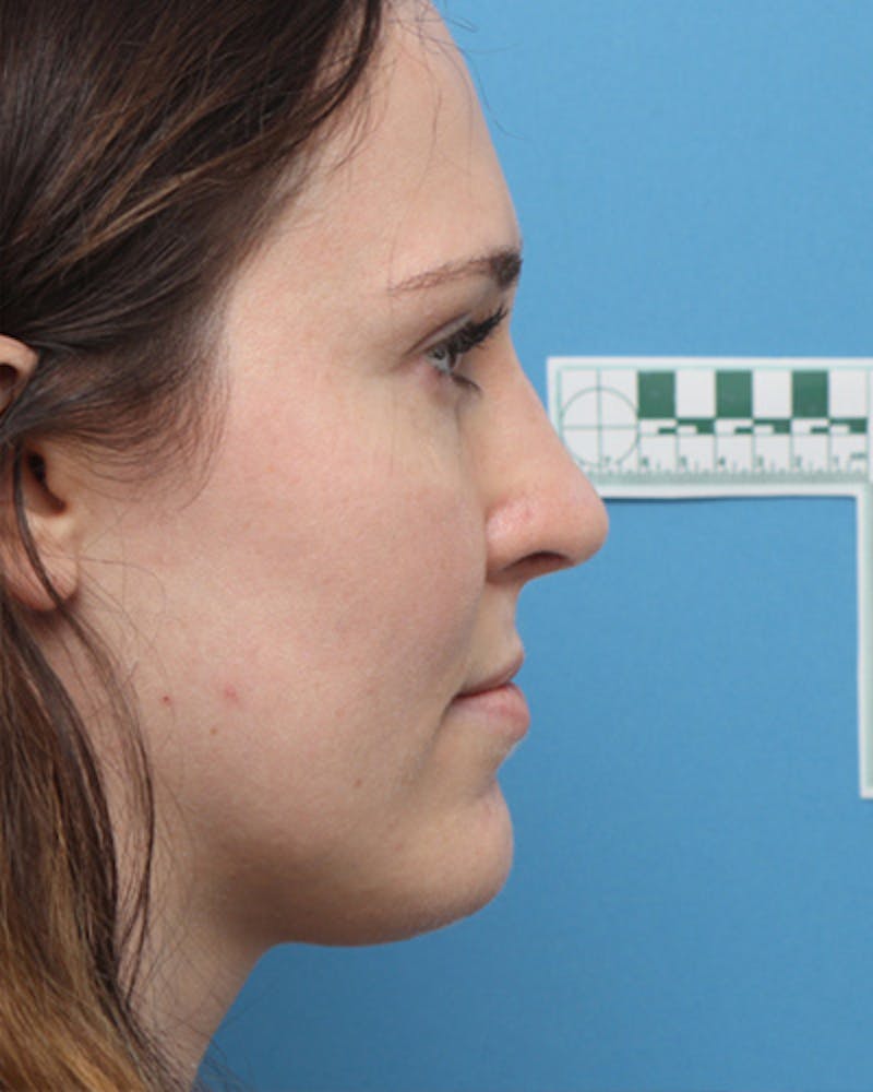 Rhinoplasty Before & After Gallery - Patient 343788 - Image 2