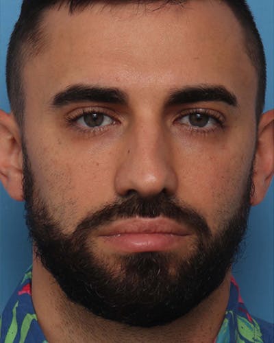 Rhinoplasty Before & After Gallery - Patient 257498 - Image 1