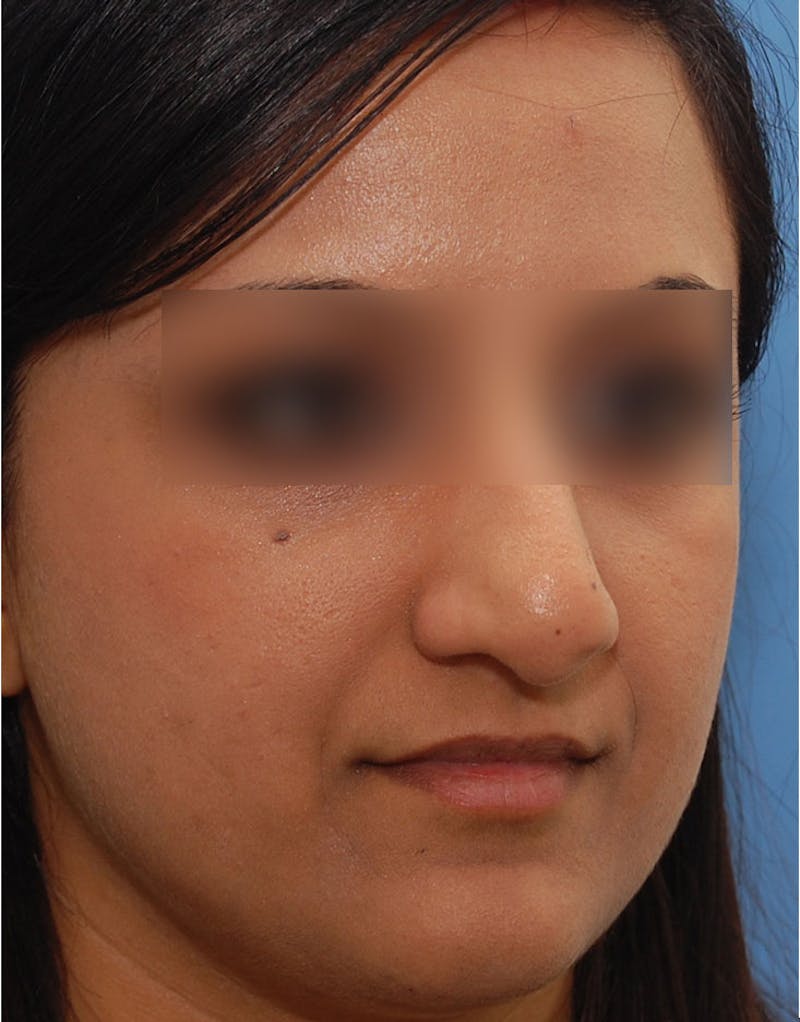 Ethnic Rhinoplasty Before & After Gallery - Patient 668309 - Image 7