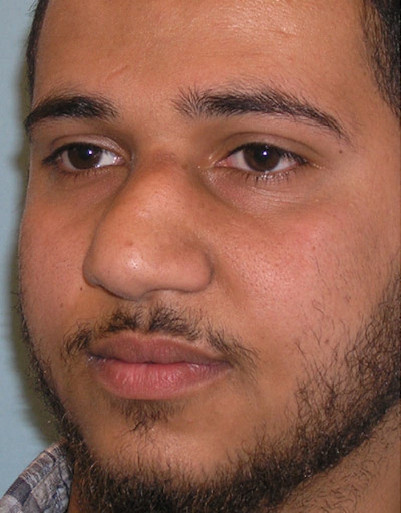 Rhinoplasty  Before & After Gallery - Patient 121039 - Image 7