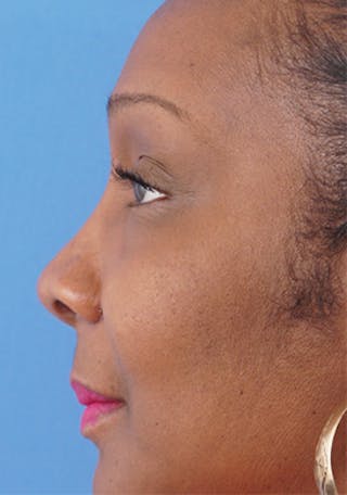 Non-Surgical Rhinoplasty Before & After Gallery - Patient 392646 - Image 4