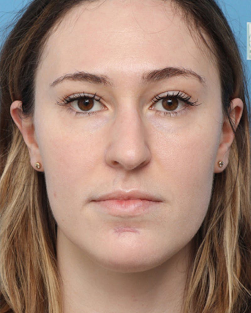 Rhinoplasty Before & After Gallery - Patient 343788 - Image 3