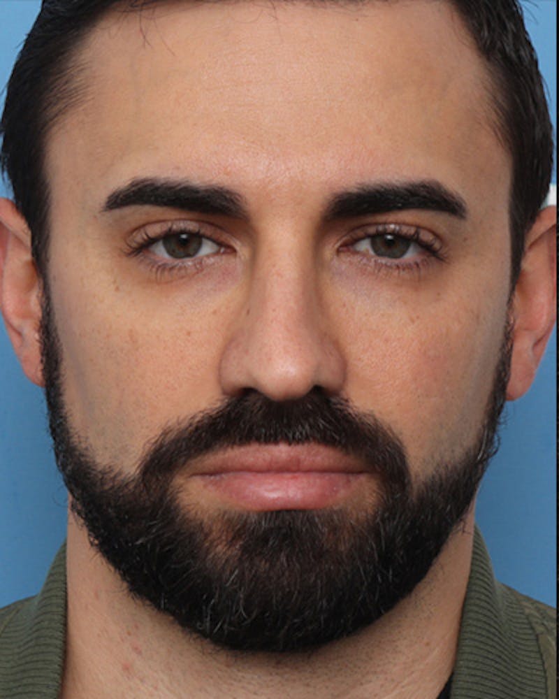 Male Rhinoplasty Before & After Gallery - Patient 221849 - Image 4