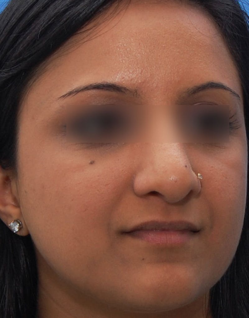 Ethnic Rhinoplasty Before & After Gallery - Patient 668309 - Image 8