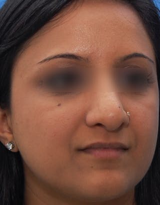 Rhinoplasty Before & After Gallery - Patient 340872 - Image 8