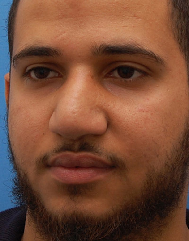 Rhinoplasty  Before & After Gallery - Patient 121039 - Image 8