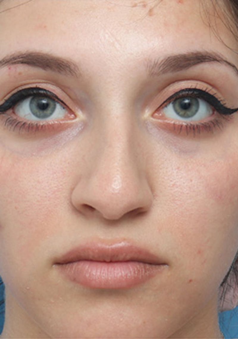 Non-Surgical Rhinoplasty Before & After Gallery - Patient 262819 - Image 1