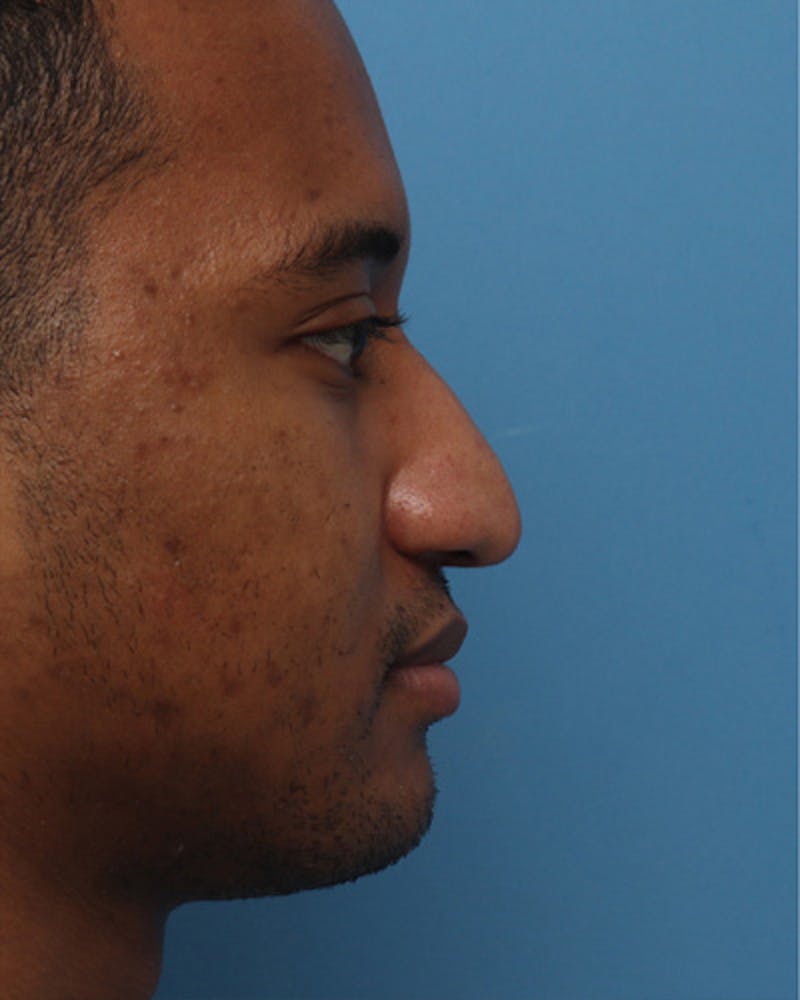 Patient ONbTuuN1SBads-4YGVBrBA - Male Rhinoplasty Before & After Photos