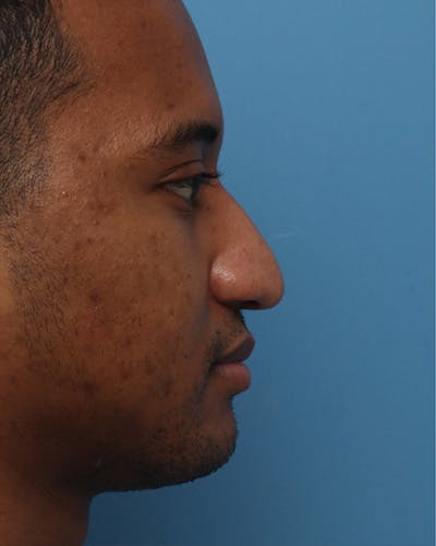 Rhinoplasty Before & After Gallery - Patient 193191 - Image 1