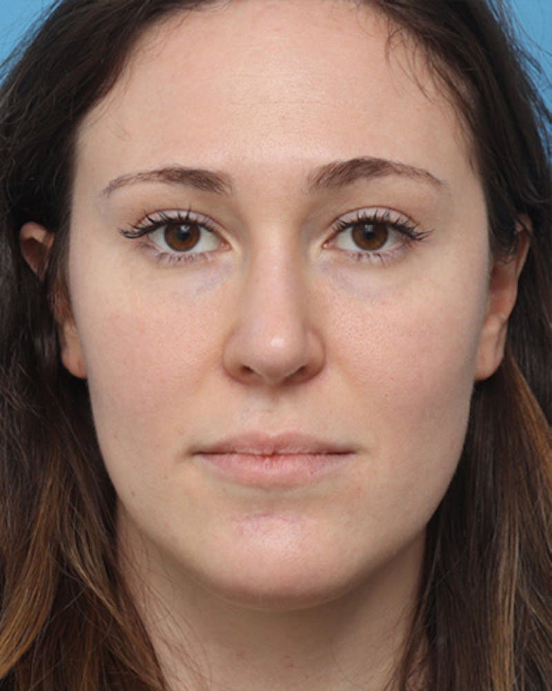 Rhinoplasty Before & After Gallery - Patient 343788 - Image 4