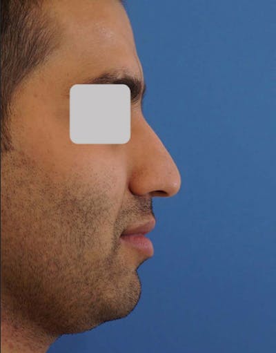 Rhinoplasty Before & After Gallery - Patient 241410 - Image 1