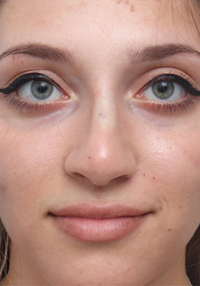 Non-Surgical Rhinoplasty Before & After Gallery - Patient 262819 - Image 2