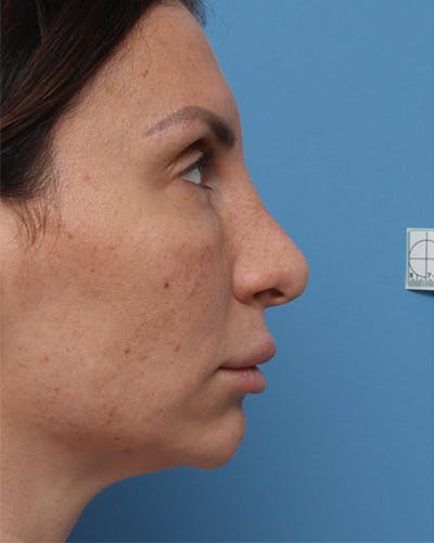 Rhinoplasty Before & After Gallery - Patient 123643 - Image 1