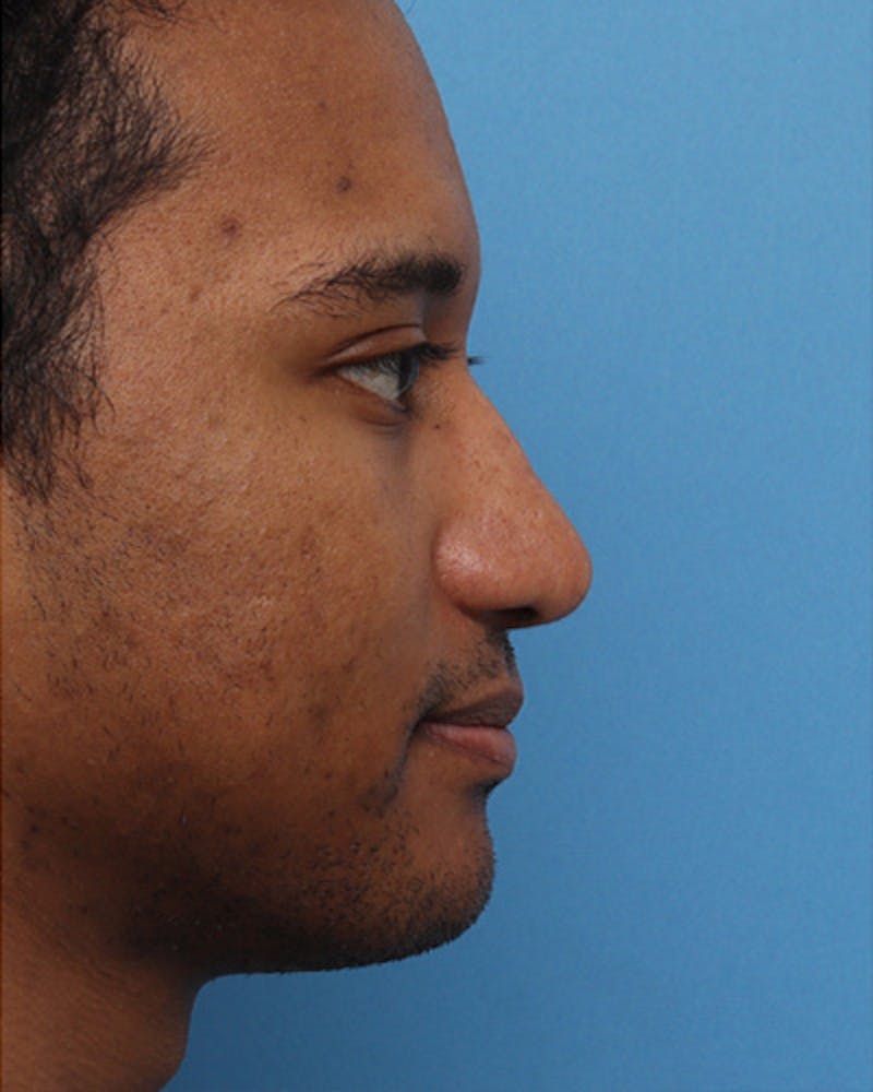 Male Rhinoplasty Before & After Gallery - Patient 279795 - Image 2