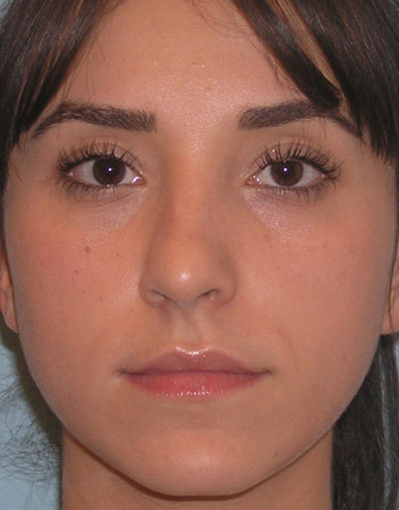 Patient WtnQVhjySBCKkTLxK-wiMA - Foundation Rhinoplasty Before & After Photos