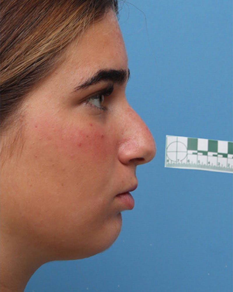 Rhinoplasty Before & After Gallery - Patient 345096 - Image 1